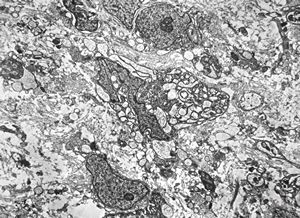 F,12y. | liposarcoma v.s.- orbita F,12y. | liposarcoma v.s.- orbita
